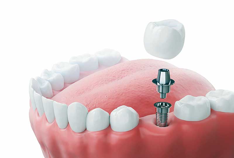 dental-implant